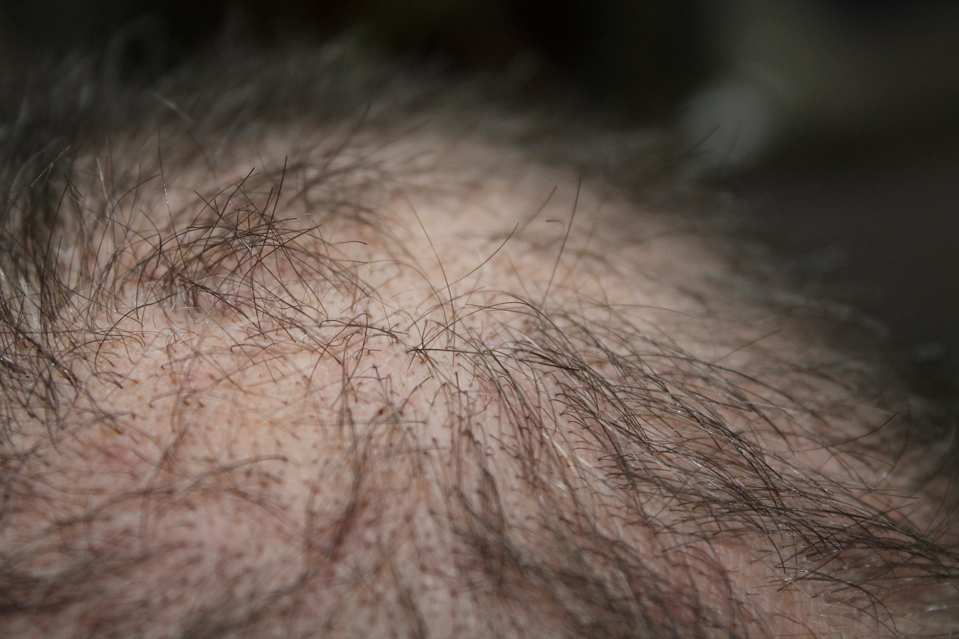 alopecie-androgenique